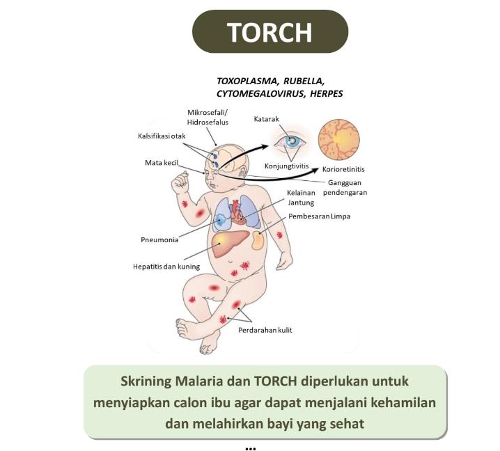 TORCH
